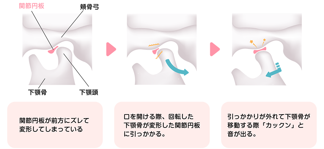 顎関節症の原因｜相模原駅ビル歯科
